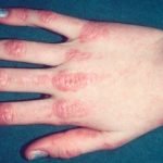 Аллергия на холод: как проявляется и что делать